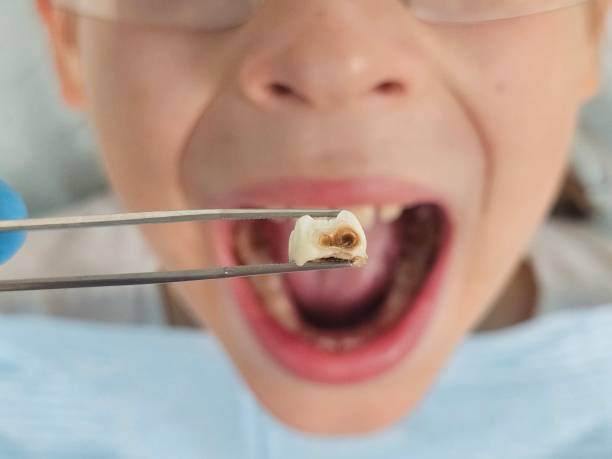 Best Emergency Dental Care for Broken or Chipped Teeth in Coleytown, CT