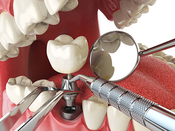 Best Emergency Tooth Extraction in Coleytown, CT